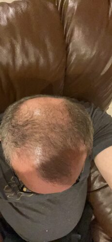 REKZE 24 Hair Growth Serum - Clinically Proven to Reduce Hair Loss & Thicken Hair photo review